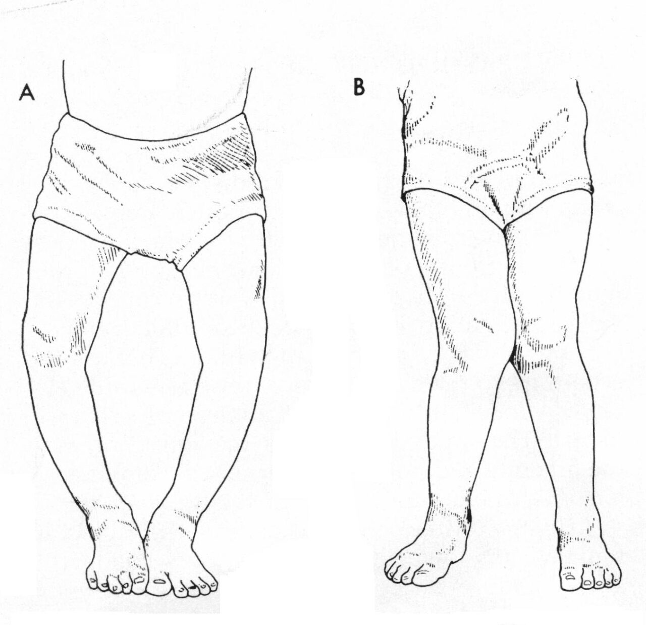 科学网—膝关节骨性关节炎主要有哪三大临床表现？ - 高绪仁的博文