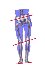 圖示長短腳的患者的盆骨歪斜膝頭呈高低