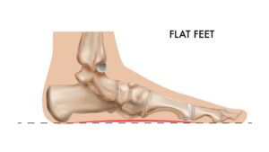 扁平足的足弓向下陷之餘舟骨亦會隨後突出