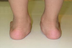 圖示扁平足引起的後足外翻