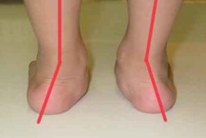 患者患扁平足同時亦有後足外翻問題