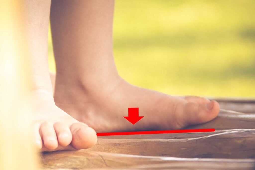 標示扁平足的足弓下陷形態