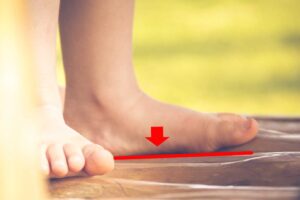 標示扁平足的足弓下陷形態