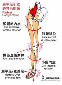 圖示扁平足會引起的連鎖性足部問題及腳痛如後足外翻、X形腳、膝蓋痛