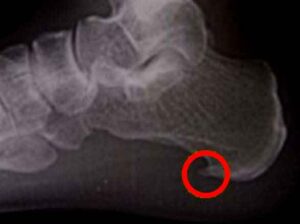 X光片顥示有明顯的骨質增生及鈣化形成的骨刺於腳跟位置