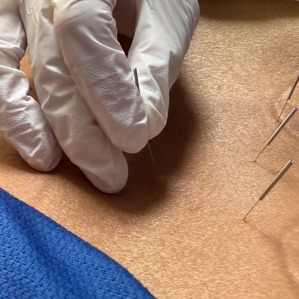 香港足脊檢查中心提供物理治療服務，其中一項為針灸